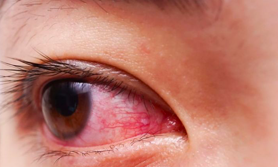 Các triệu chứng của bệnh đau mắt đỏ