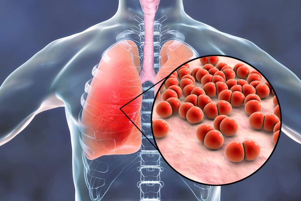Nguyên nhân gây viêm phổi có thể do vi khuẩn, virus hoặc do nấm
